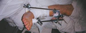 Car Accident injury victim in a hospital after surgery with a plate and screws in leg. Protect yourself with BI insurance coverage if you are injured in an accident.